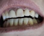 Имплантация в области фронтальной группы зубов